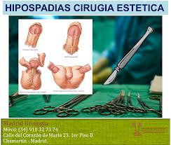 Facts about hypospadias (información sobre el hipospadias). Madrid Urologia Hipospadias Patologia Del Pene Mu