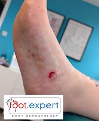 Image result for pompholyx soles of feet