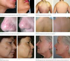 Patients say that treatments are practically painless. Gentlemax Pro Laser Treatments Shades Valley Dermatology