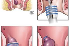 Maybe you would like to learn more about one of these? Hemorrhoids The Definitive Guide To Medical And Surgical Treatment Consult Qd