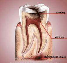 Điều trị tủy răng bằng Guttapercha nóng chảy