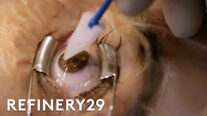 What Getting Laser Eye Surgery Is Really Like Macro Beauty Refinery29 Youtube