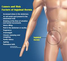 Image result for Inguinal hernia man
