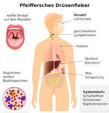 Bei kindern unter zehn jahren auch raten einige ärzte zu einer entfernung der mandeln, um den krankheitsverlauf zu verkürzen. Pfeiffersches Drusenfieber Symptome Dauer Ansteckung Behandlung