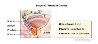 The following clinical stages are used to describe prostate cancer: Definition Of Stage Ii Prostate Cancer Nci Dictionary Of Cancer Terms National Cancer Institute