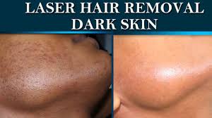 One of the biggest areas of contention with laser hair removal treatment is whether it can be used on people with darker skin. Laser Hair Removal At Dermalogics Before After On Dark Skin Youtube
