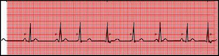 Heart arrhythmias a wandering atrial pacemaker is a type of heart arrhythmia. Quia Ekg