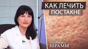 как убрать лопнувшие сосуды на лице в домашних условиях Lechenie Kuperoza Na Lice V Domashnih Usloviyah Kuperoz Chto Eto Youtube