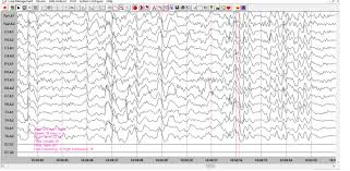 Image result for AIDS Dementia Complex