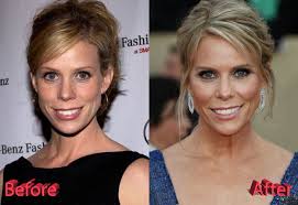 13.02.2019 · people couldn't recognise grey after plastic surgery. Cheryl Hines Plastic Surgery Looking Gorgeous As Ever