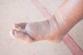 We did not find results for: Penyebab Buah Pinggang Rosak Ada Kaitan Dengan Diabetes