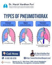 Image result for Open Pneumothorax