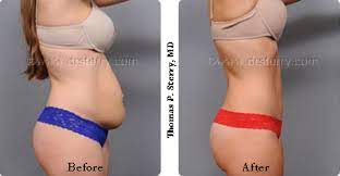 Sep 26, 2020 · a tummy tuck surgery is an elective cosmetic surgery that you might consider if you want to have a flatter, firmer appearing stomach. Tummy Tuck Before And After Pictures Details Plastic Surgery News For New York City From Dr Thomas P Sterry