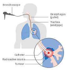 You don't have any signs or symptoms of lung cancer. Lung Cancer Wikipedia