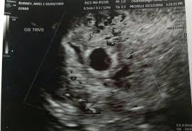 The best proof is our gallery of weekly 3d ultrasound images taken from 13 weeks and until up to 39 weeks. 6 Weeks Pregnant Ultrasound 2021 Novocom Top