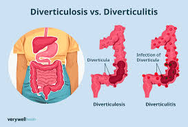 Image result for Diverticulitis