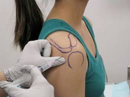 Image result for Subacromial Space Injection