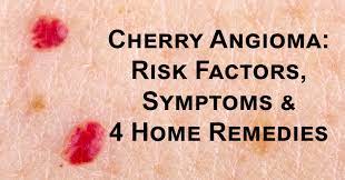 There are no risk factors for the condition Cherry Angioma Risk Factors Symptoms 4 Home Remedies David Avocado Wolfe
