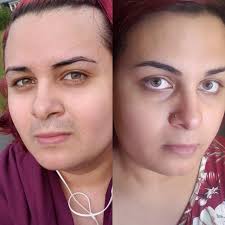 I wanted to share my results and thoughts because i have gotten very different results from all the other reviews i've read. Laser Hair Removal For Dark Facial Hair Results 1 Session 1 Day No Shave Transtimelines