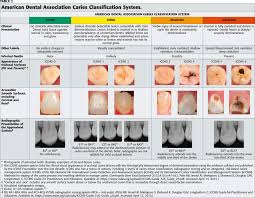 The following two categories (code 3 and 4, in red) are considered caries that extend to the enamel without exposed dentine. The American Dental Association Caries Classification System For Clinical Practice The Journal Of The American Dental Association