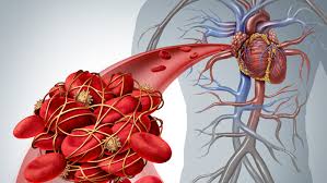 L'embolia polmonare è una patologia causata dall'ostruzione di un vaso sanguigno a livello del polmone. Embolia Polmonare Quali Sono I Sintomi Ok Salute