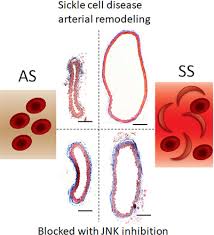 It is caused by homozygous. Sickle Cell Anemia Mediates Carotid Artery Expansive Remodeling That Can Be Prevented By Inhibition Of Jnk C Jun N Terminal Kinase Arteriosclerosis Thrombosis And Vascular Biology
