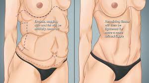 Check spelling or type a new query. Factors That Affect Body Contouring After Massive Weight Loss Cost