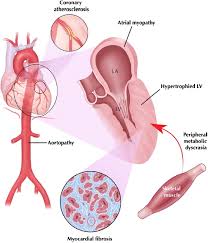 Image result for Angina Pectoris