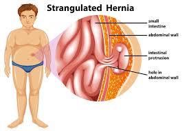 Image result for Hernia Reduction