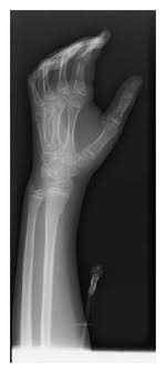 Maybe you would like to learn more about one of these? Radiographs Of Left Wrist Showing Apex Dorsal Distal Radius Buckle Download Scientific Diagram