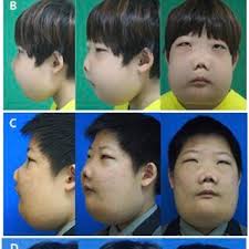 Facial appearance of the patient showing no definite resolution of...