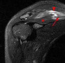 Parsonage Turner Syndrome Radsource