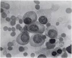 A dictionary of nursing dictionary. Myelomatosis With The A2 Type Serum Protein Pattern Sciencedirect