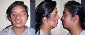 10 Rarest Diseases In The World Rarest Org