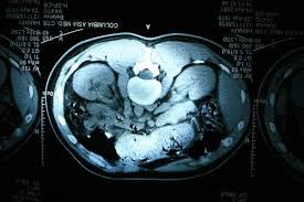 Http Bbishare Com Kidney Mass Html Should You Have Some Sort Of Renal Mass And Wish To Find Out What It Could Be Read This Article Kidney Mass Kidney Renal