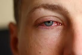 Nama perubatan iaitu konjunktivitis ada kaitan dengan selaput konjunktiva. 4 Penyebab Mata Merah Dan Cara Menghilangkannya Halaman All Kompas Com
