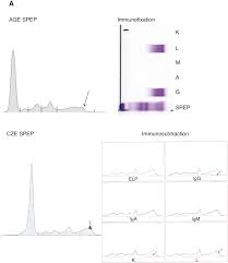 Increasing evidence for a multistep transformation process. An International Multi Center Serum Protein Electrophoresis Accuracy And M Protein Isotyping Study Part Ii Limit Of Detection And Follow Up Of Patients With Small M Proteins