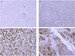 Maybe you would like to learn more about one of these? Ntrk And Alk Rearrangements In Malignant Pleural Mesothelioma Pulmonary Neuroendocrine Tumours And Non Small Cell Lung Cancer Lung Cancer