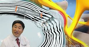 This Video Explains The Differences Between The Terms Bulging Disc Slipped Disc And Herniated Disc Degenerative Disc Disease Degenerative Disc Herniated Disc