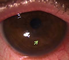 Any disease that can affect the clarity or refractive capability of the cornea in childhood can have devastating consequences as a result of refractive or deprivational amblyopia. Be A Hero To Your Hsvk Patients
