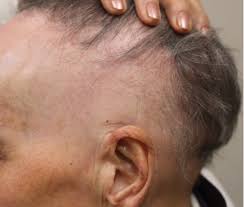 Lichen planus is an inflammatory disease that can cause permanent, scarring hair loss.recent studies indicate that there may also be a genetic hereditary component in some types of lichen planus cicatricial alopecias. Is Immunotherapy Dpcp Sadbe Effective For Lichen Planopilaris Or Frontal Fibrosing Alopecia Donovan Hair Clinic