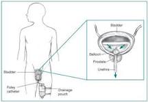 Image result for icd 9 code for prostatic hypertrophy