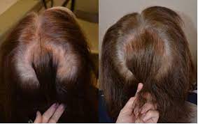 Although it's not formally fda approved for use in women, the medication has been prescribed to women with androgenetic alopecia for nearly two decades. Finasteride Females Before After Photos Hair Restoration Of The South New Orleans La