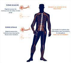 Environ 500 000 personnes dans le monde sont atteintes de la maladie de charcot. Les Signes Et Symptomes De La Maladie De Charcot Sla Icm