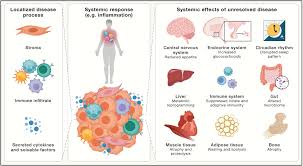 Image result for Cachexia in Cancer