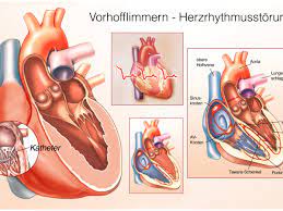 Herzrhythmusstorungen Neue Heilende Therapie Gegen Vorhofflimmern Heilpraxis