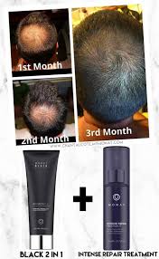 Biotin Shampoo Before And After Men Pin By Claudy Mizirawi On Monat Skin Hair In 2020 Hair Loss Men Help Hair Loss Hair Loss Solutions