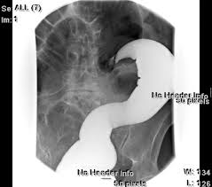 Image result for Sigmoid Volvulus