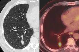 To establish the protocol for ldct screening pilot study in taiwan establishing working. Ldct Lung Cancer Screening Program