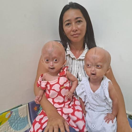 Mãe de gêmeas com velhice precoce luta pela vida das filhas em RR